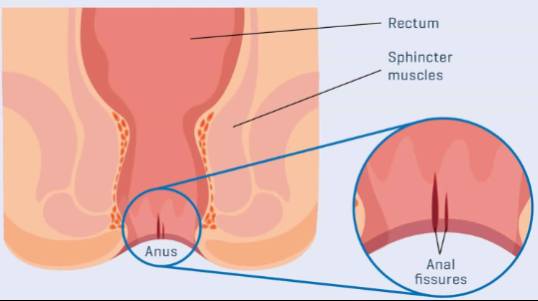 Anal Fissure Laser Treatment