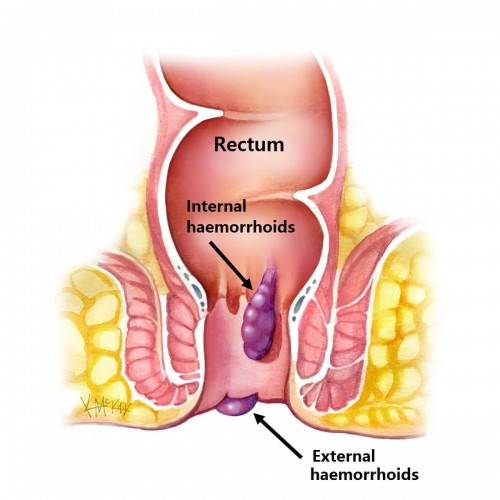 Internal Hemorrhoids Symptoms in Females