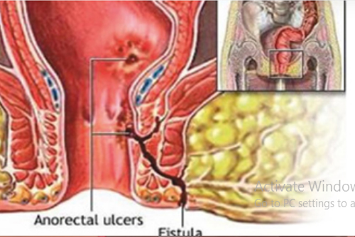 Anal Fistula Laser Treatment in Miyapur, Hyderabad