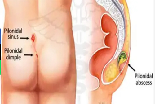 Laser Treatment for Pilonidal Sinus in Miyapur, Hyderabad