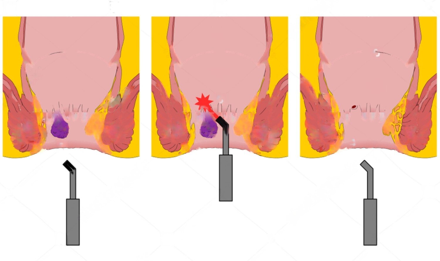 Laser Treatment Piles(Hemorrhoids) in Miyapur, Hyderabad