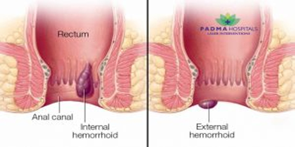 Laser Piles and Fissures Treatment in Miyapur, Hyderabad