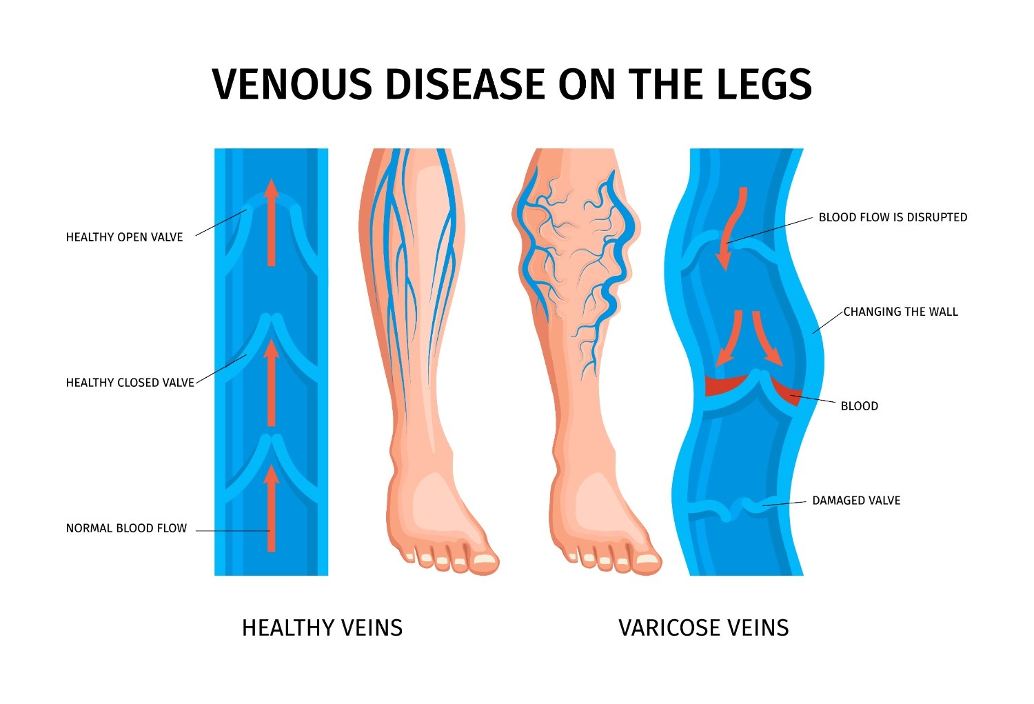 Varicose Veins Laser Treatment in Miyapur, Hyderabad